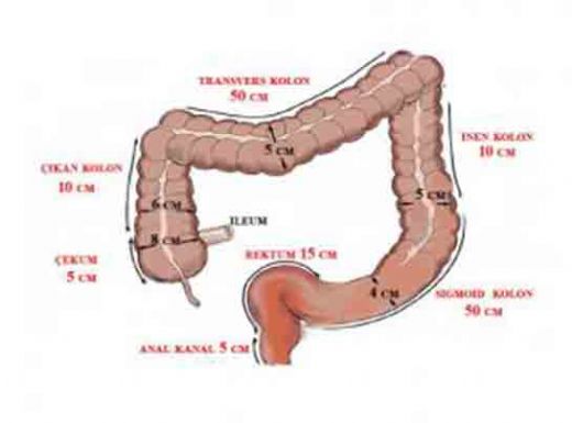 Bağırsak Duvarı Kalınlaşması Belirtileri ve Tedavisi