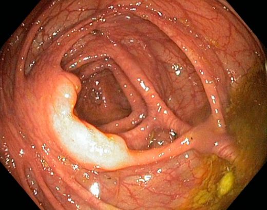 Bağırsak İlaçları Kullanımı ve Faydaları Nelerdir?