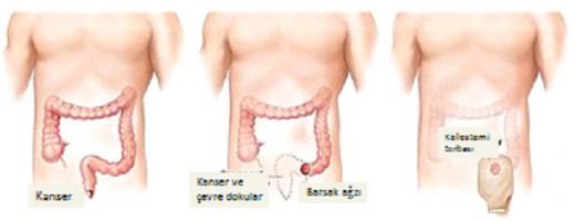 Bağırsak Kanseri Öldürürmü?