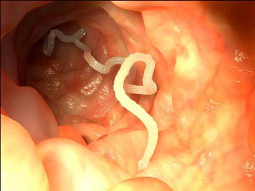 Bağırsak Kıl Kurdu Belirtileri ve Tedavisi