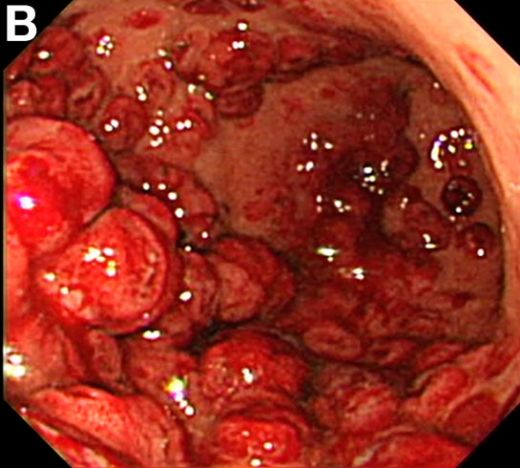 Bağırsak Mantarı Belirtileri ve Tedavisi