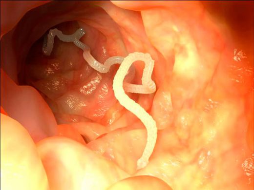 Bebeklerde Bağırsak Kurdu Belirtileri ve Tedavisi