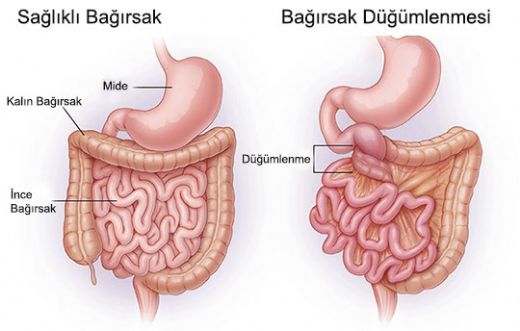 Çocuklarda Bağırsak Düğümlenmesi Nedenleri?