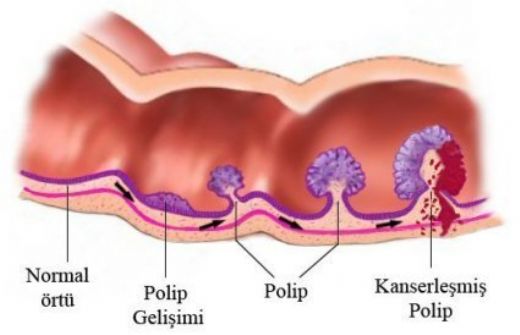 Kalın Bağırsak Tümörü Belirtileri ve Tedavisi