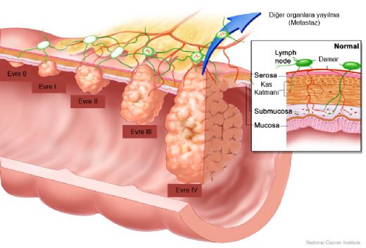 Kalın Bağırsakta Kitle Belirtileri ve Tedavisi