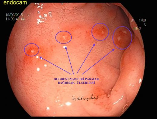 Oniki Parmak Bağırsağı Ülseri Belirtileri ve Tedavisi