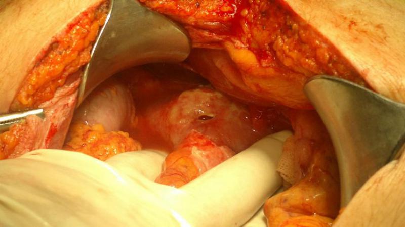 Bağırsak Delinmesi Ameliyatı Riskleri ve Sonrası